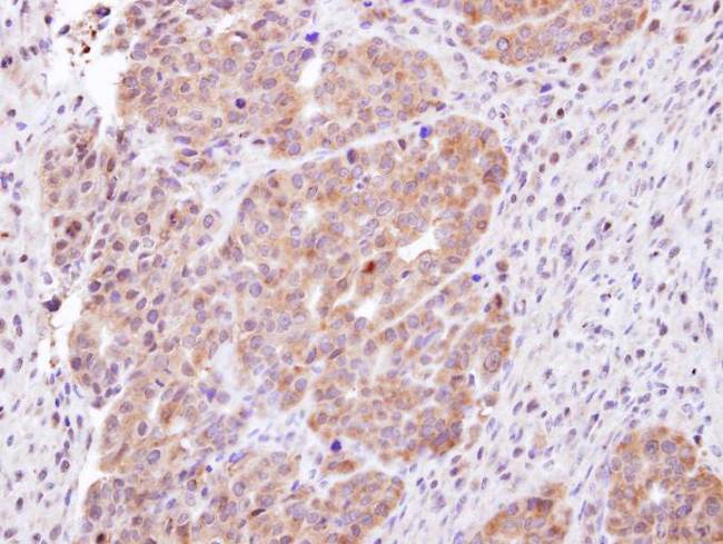 Vps60 / CHMP5 Antibody - IHC of paraffin-embedded NCIN87 xenograft using CHMP5 antibody at 1:100 dilution.