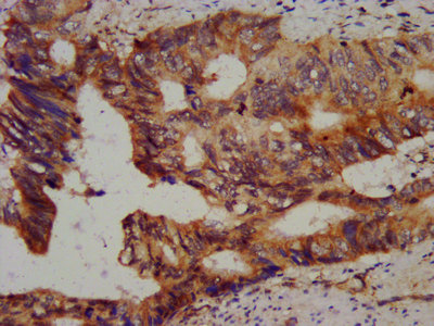 Vps60 / CHMP5 Antibody - IHC image of CHMP5 Antibody diluted at 1:800 and staining in paraffin-embedded human colon cancer performed on a Leica BondTM system. After dewaxing and hydration, antigen retrieval was mediated by high pressure in a citrate buffer (pH 6.0). Section was blocked with 10% normal goat serum 30min at RT. Then primary antibody (1% BSA) was incubated at 4°C overnight. The primary is detected by a biotinylated secondary antibody and visualized using an HRP conjugated SP system.
