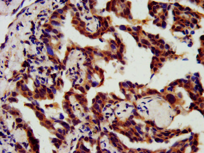 Vps60 / CHMP5 Antibody - IHC image of CHMP5 Antibody diluted at 1:800 and staining in paraffin-embedded human lung cancer performed on a Leica BondTM system. After dewaxing and hydration, antigen retrieval was mediated by high pressure in a citrate buffer (pH 6.0). Section was blocked with 10% normal goat serum 30min at RT. Then primary antibody (1% BSA) was incubated at 4°C overnight. The primary is detected by a biotinylated secondary antibody and visualized using an HRP conjugated SP system.