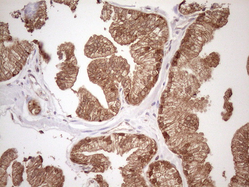 Vps60 / CHMP5 Antibody - Immunohistochemical staining of paraffin-embedded Carcinoma of Human prostate tissue using anti-CHMP5 mouse monoclonal antibody. (Heat-induced epitope retrieval by 1mM EDTA in 10mM Tris buffer. (pH8.5) at 120 oC for 3 min. (1:150)