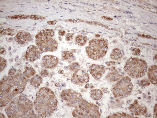 Vps60 / CHMP5 Antibody - Immunohistochemical staining of paraffin-embedded Carcinoma of Human liver tissue using anti-CHMP5 mouse monoclonal antibody. (Heat-induced epitope retrieval by 1mM EDTA in 10mM Tris buffer. (pH8.5) at 120 oC for 3 min. (1:150)