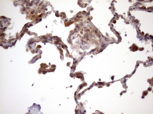 Vps60 / CHMP5 Antibody - Immunohistochemical staining of paraffin-embedded Carcinoma of Human lung tissue using anti-CHMP5 mouse monoclonal antibody. (Heat-induced epitope retrieval by Tris-EDTA, pH8.0)(1:150)