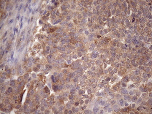 Vps60 / CHMP5 Antibody - Immunohistochemical staining of paraffin-embedded Adenocarcinoma of Human ovary tissue using anti-CHMP5 mouse monoclonal antibody. (Heat-induced epitope retrieval by Tris-EDTA, pH8.0)(1:150)