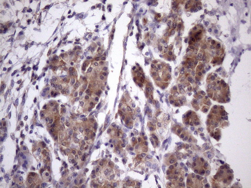 Vps60 / CHMP5 Antibody - Immunohistochemical staining of paraffin-embedded Carcinoma of Human pancreas tissue using anti-CHMP5 mouse monoclonal antibody. (Heat-induced epitope retrieval by Tris-EDTA, pH8.0)(1:150)