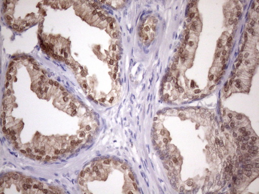 Vps60 / CHMP5 Antibody - Immunohistochemical staining of paraffin-embedded Human prostate tissue within the normal limits using anti-CHMP5 mouse monoclonal antibody. (Heat-induced epitope retrieval by Tris-EDTA, pH8.0)(1:150)