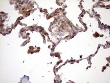 Vps60 / CHMP5 Antibody - IHC of paraffin-embedded Carcinoma of Human lung tissue using anti-CHMP5 mouse monoclonal antibody. (Heat-induced epitope retrieval by Tris-EDTA, pH8.0)(1:150).