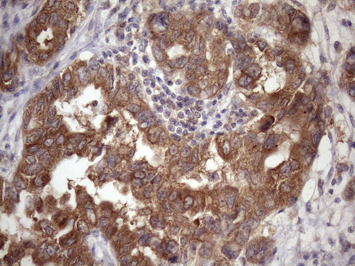 Vps60 / CHMP5 Antibody - IHC of paraffin-embedded Adenocarcinoma of Human endometrium tissue using anti-CHMP5 mouse monoclonal antibody. (Heat-induced epitope retrieval by Tris-EDTA, pH8.0)(1:150).