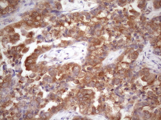 Vps60 / CHMP5 Antibody - Immunohistochemical staining of paraffin-embedded Adenocarcinoma of Human endometrium tissue using anti-CHMP5 mouse monoclonal antibody. (Heat-induced epitope retrieval by 1mM EDTA in 10mM Tris buffer. (pH8.5) at 120 oC for 3 min. (1:150)
