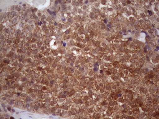 Vps60 / CHMP5 Antibody - Immunohistochemical staining of paraffin-embedded Adenocarcinoma of Human breast tissue using anti-CHMP5 mouse monoclonal antibody. (Heat-induced epitope retrieval by 1mM EDTA in 10mM Tris buffer. (pH8.5) at 120 oC for 3 min. (1:150)