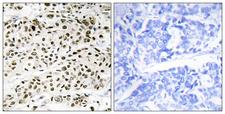 VPS72 Antibody - Peptide - + Immunohistochemistry analysis of paraffin-embedded human breast carcinoma tissue using VPS72 antibody.