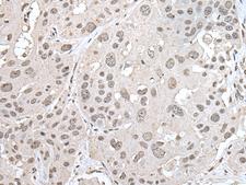 VRK1 Antibody - Immunohistochemistry of paraffin-embedded Human esophagus cancer tissue  using VRK1 Polyclonal Antibody at dilution of 1:30(×200)