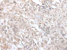 VRK3 Antibody - Immunohistochemistry of paraffin-embedded Human lung cancer tissue  using VRK3 Polyclonal Antibody at dilution of 1:45(×200)