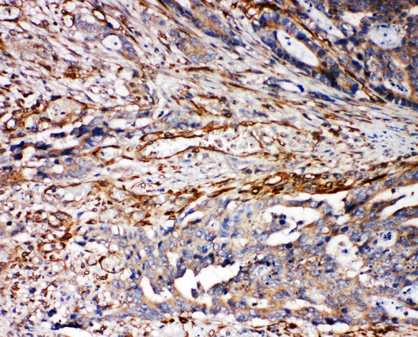 VRL1 / TRPV2 Antibody - VRL1 / TRPV2 antibody. IHC(P): Human Breast Cancer Tissue.