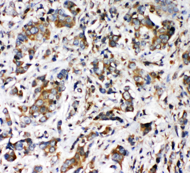 VRL1 / TRPV2 Antibody - VRL1 / TRPV2 antibody. IHC(P): Human Intestinal Cancer Tissue.