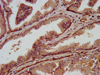 VRL1 / TRPV2 Antibody - IHC image of TRPV2 Antibody diluted at 1:800 and staining in paraffin-embedded human prostate tissue performed on a Leica BondTM system. After dewaxing and hydration, antigen retrieval was mediated by high pressure in a citrate buffer (pH 6.0). Section was blocked with 10% normal goat serum 30min at RT. Then primary antibody (1% BSA) was incubated at 4°C overnight. The primary is detected by a biotinylated secondary antibody and visualized using an HRP conjugated SP system.