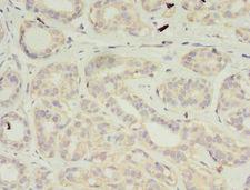 VSIG2 Antibody - Immunohistochemistry of paraffin-embedded human breast cancer using antibody at 1:100 dilution.  This image was taken for the unconjugated form of this product. Other forms have not been tested.
