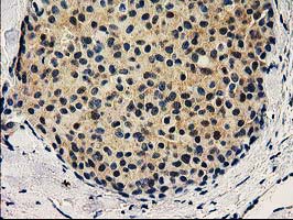 VSIG2 Antibody - IHC of paraffin-embedded Adenocarcinoma of Human breast tissue using anti-VSIG2 mouse monoclonal antibody.