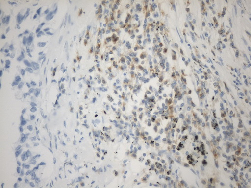 VSIR / GI24 / VISTA Antibody - Immunohistochemical staining of paraffin-embedded Carcinoma of Human lung tissue using anti-VISTA(C10ORF54) mouse monoclonal antibody. (Heat-induced epitope retrieval by 1mM EDTA in 10mM Tris buffer. (pH8.0) at 120°C for 2.5 min. (1:50)