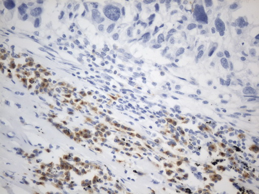 VSIR / GI24 / VISTA Antibody - Immunohistochemical staining of paraffin-embedded Carcinoma of Human lung tissue using anti-VISTA(C10ORF54) mouse monoclonal antibody. (Heat-induced epitope retrieval by 1mM EDTA in 10mM Tris buffer. (pH8.0) at 120°C for 2.5 min. (1:200)