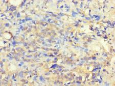 VTA1 Antibody - Immunohistochemistry of paraffin-embedded human gastric cancer using VTA1 Antibody at dilution of 1:100
