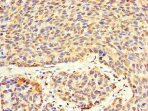 VTA1 Antibody - Immunohistochemistry of paraffin-embedded human ovarian cancer using VTA1 Antibody at dilution of 1:100
