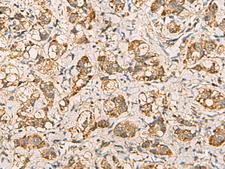 VTA1 Antibody - Immunohistochemistry of paraffin-embedded Human liver cancer tissue  using VTA1 Polyclonal Antibody at dilution of 1:60(×200)