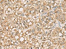 VTA1 Antibody - Immunohistochemistry of paraffin-embedded Human liver cancer tissue  using VTA1 Polyclonal Antibody at dilution of 1:85(×200)