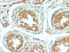VTCN1 / B7-H4 Antibody - Formalin-fixed, paraffin-embedded human Testicular Carcinoma stained with B7-H4 Rabbit Recombinant Monoclonal Antibody (B7H4/2652R).