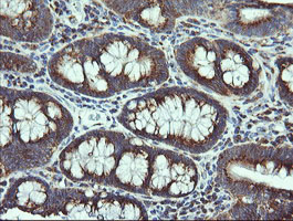 VTI1A Antibody - IHC of paraffin-embedded Adenocarcinoma of Human colon tissue using anti-VTI1A mouse monoclonal antibody. (Heat-induced epitope retrieval by 10mM citric buffer, pH6.0, 120°C for 3min).