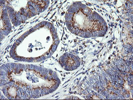 VTI1A Antibody - IHC of paraffin-embedded Carcinoma of Human pancreas tissue using anti-VTI1A mouse monoclonal antibody. (Heat-induced epitope retrieval by 10mM citric buffer, pH6.0, 120°C for 3min).