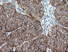 VTI1A Antibody - IHC of paraffin-embedded Adenocarcinoma of Human ovary tissue using anti-VTI1A mouse monoclonal antibody. (Heat-induced epitope retrieval by 10mM citric buffer, pH6.0, 120°C for 3min).