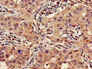 VTI1A Antibody - Immunohistochemistry of paraffin-embedded human lung cancer using VTI1A Antibody at dilution of 1:100