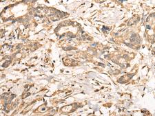 VTI1A Antibody - Immunohistochemistry of paraffin-embedded Human gastric cancer tissue  using VTI1A Polyclonal Antibody at dilution of 1:35(×200)