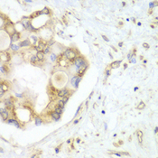 VTI1B Antibody - Immunohistochemistry of paraffin-embedded human liver cancer tissue.