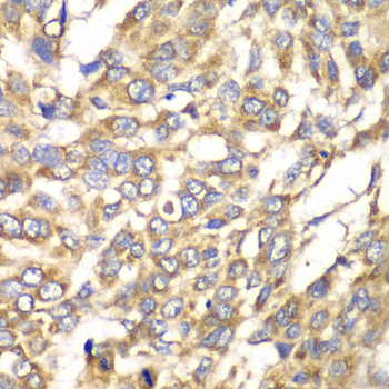 VTI1B Antibody - Immunohistochemistry of paraffin-embedded human esophageal cancer tissue.