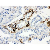 VTN / Vitronectin Antibody - Vitronectin antibody IHC-paraffin. IHC(P): Human Lung Cancer Tissue.