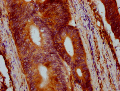VTN / Vitronectin Antibody - Immunohistochemistry Dilution at 1:400 and staining in paraffin-embedded human colon cancer performed on a Leica BondTM system. After dewaxing and hydration, antigen retrieval was mediated by high pressure in a citrate buffer (pH 6.0). Section was blocked with 10% normal Goat serum 30min at RT. Then primary antibody (1% BSA) was incubated at 4°C overnight. The primary is detected by a biotinylated Secondary antibody and visualized using an HRP conjugated SP system.