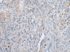 VWA2 Antibody - Immunohistochemistry of paraffin-embedded Human lung cancer tissue  using VWA2 Polyclonal Antibody at dilution of 1:45(×200)