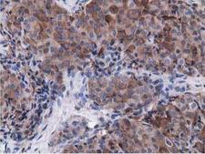 VWA5A Antibody - IHC of paraffin-embedded Adenocarcinoma of Human breast tissue using anti-VWA5A mouse monoclonal antibody.