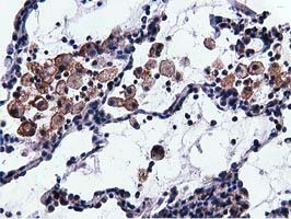 VWA5A Antibody - IHC of paraffin-embedded Carcinoma of Human lung tissue using anti-VWA5A mouse monoclonal antibody.