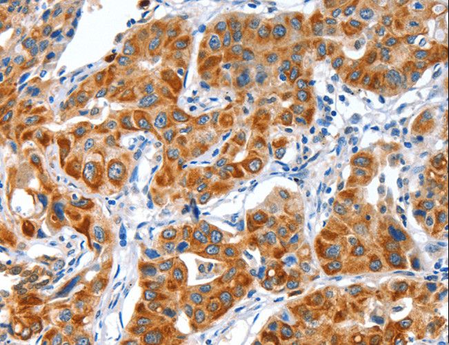VWA5A Antibody - Immunohistochemistry of paraffin-embedded Human lung cancer using VWA5A Polyclonal Antibody at dilution of 1:80.