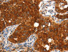 VWA5A Antibody - Immunohistochemistry of paraffin-embedded Human lung cancer using VWA5A Polyclonal Antibody at dilution of 1:60.
