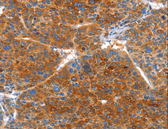 VWA5A Antibody - Immunohistochemistry of paraffin-embedded Human liver cancer using VWA5A Polyclonal Antibody at dilution of 1:60.