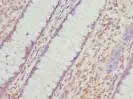 VWA9 / C15orf44 Antibody - Immunohistochemistry of paraffin-embedded human colon cancer using antibody at dilution of 1:100.