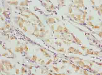 VWA9 / C15orf44 Antibody - Immunohistochemistry of paraffin-embedded human gastric cancer using antibody at dilution of 1:100.