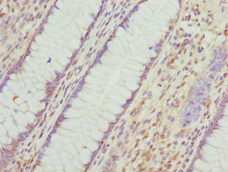 VWA9 / C15orf44 Antibody - Immunohistochemistry of paraffin-embedded human colon cancer using INTS14 Antibody at dilution of 1:100