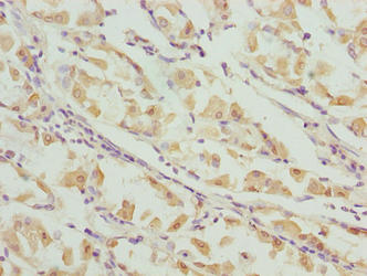 VWA9 / C15orf44 Antibody - Immunohistochemistry of paraffin-embedded human gastric cancer using INTS14 Antibody at dilution of 1:100