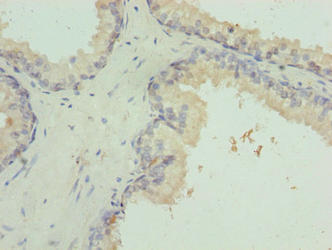 VWA9 / C15orf44 Antibody - Immunohistochemistry of paraffin-embedded human prostate cancer using INTS14 Antibody at dilution of 1:100