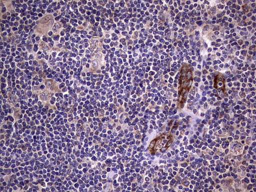 VWF / Von Willebrand Factor Antibody - IHC of paraffin-embedded Human lymphoma tissue using anti-VWF mouse monoclonal antibody. (Heat-induced epitope retrieval by 1 mM EDTA in 10mM Tris, pH8.5, 120°C for 3min).