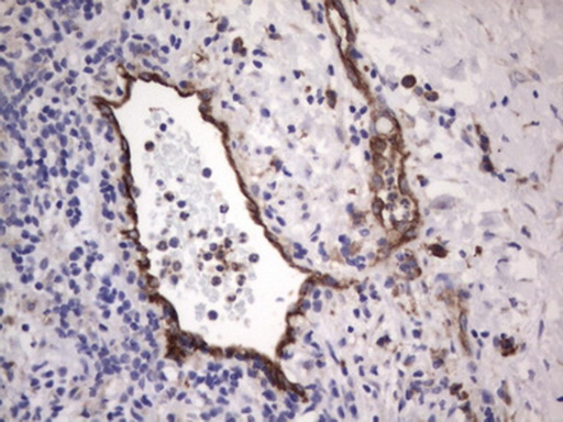 VWF / Von Willebrand Factor Antibody - IHC of paraffin-embedded Carcinoma of Human pancreas tissue using anti-VWF mouse monoclonal antibody. (Heat-induced epitope retrieval by 1 mM EDTA in 10mM Tris, pH8.5, 120°C for 3min).